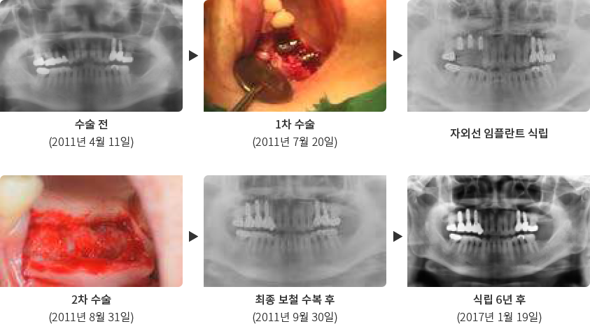 수술전,1차수술, 자외선 임플란트 식립, 2차 수술, 최종보철수복 후, 식립 6년후 이미지