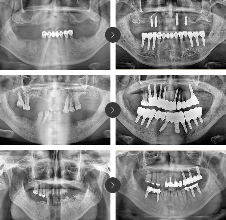 임플란트 전후케이스 이미지