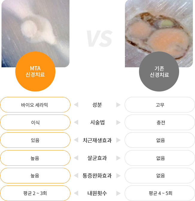 MTA 신경치료 vs 기존 신경치료 표